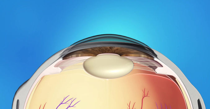 Pediatrics Animation: Cataract Surgery